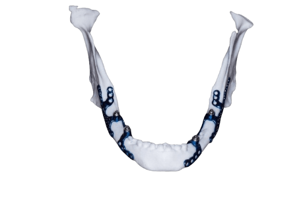 Mandibular Subperiosteal Implant