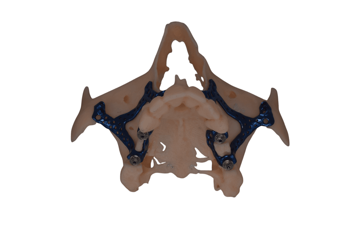Regional maxillary subperiosteal Implant