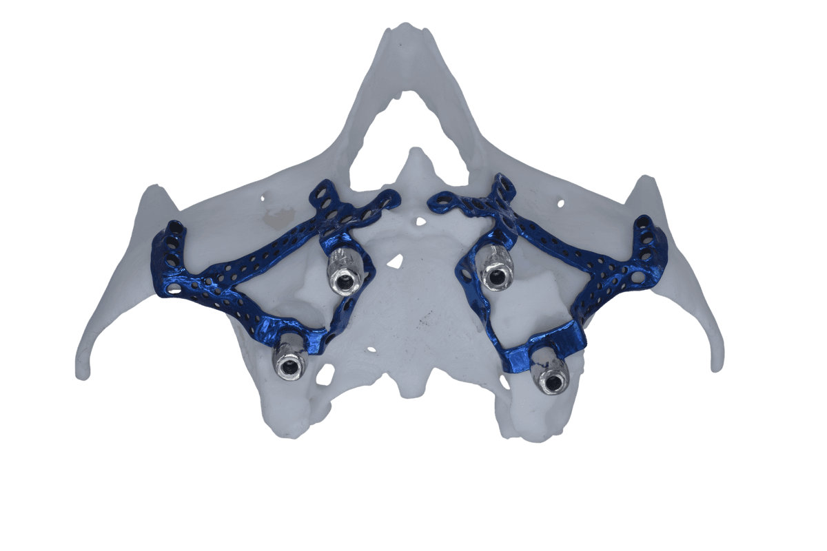 Maxillary Subperiosteal Implant