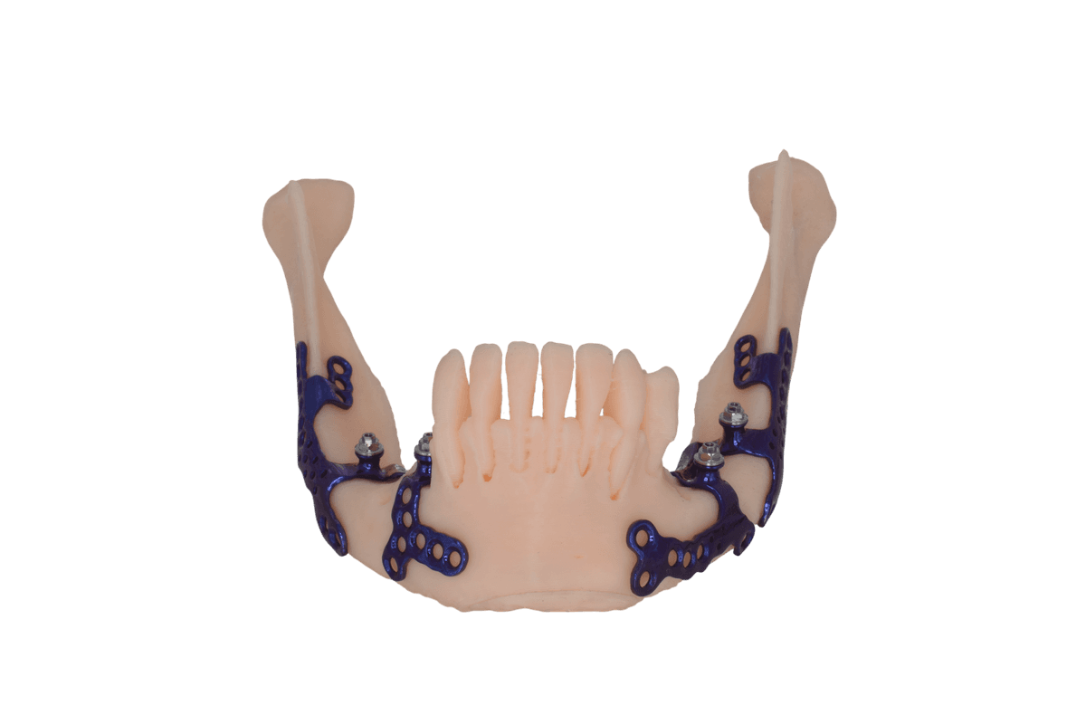 Regional Mandibular Subperiosteal Implant